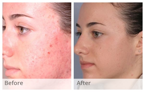 Chemical Peel in London