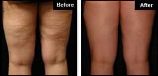 London Cellulite Treatment Example