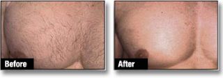 Laser Hair Removal Men