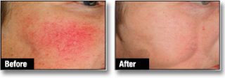 Rosacea Treatment London Before and After