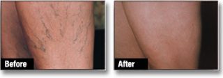 Spider Veins Treatment London Before and After