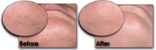 Women Laser Hair Removal London