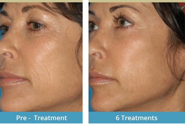 AQ Skin Solution Results London