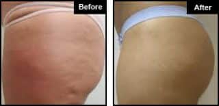 cellulite treatment London example