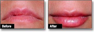 Dermal filler before & after 1