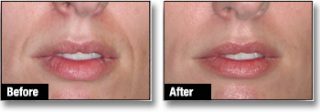 Dermal filler before & after 3
