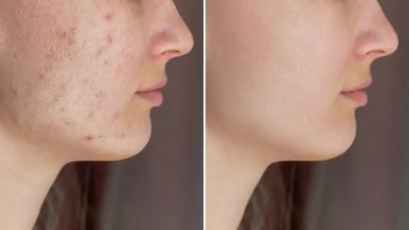 Acne Before and After Treatment-min Acne Before and After Treatment-min