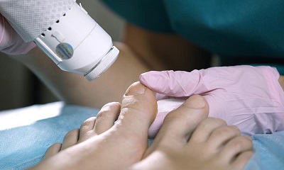 NDYAG Laser
