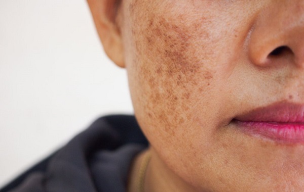 Skin Pigmentation Treatment in London